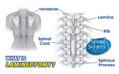 Laminectomy