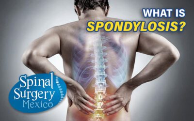 Spinal Spondylosis