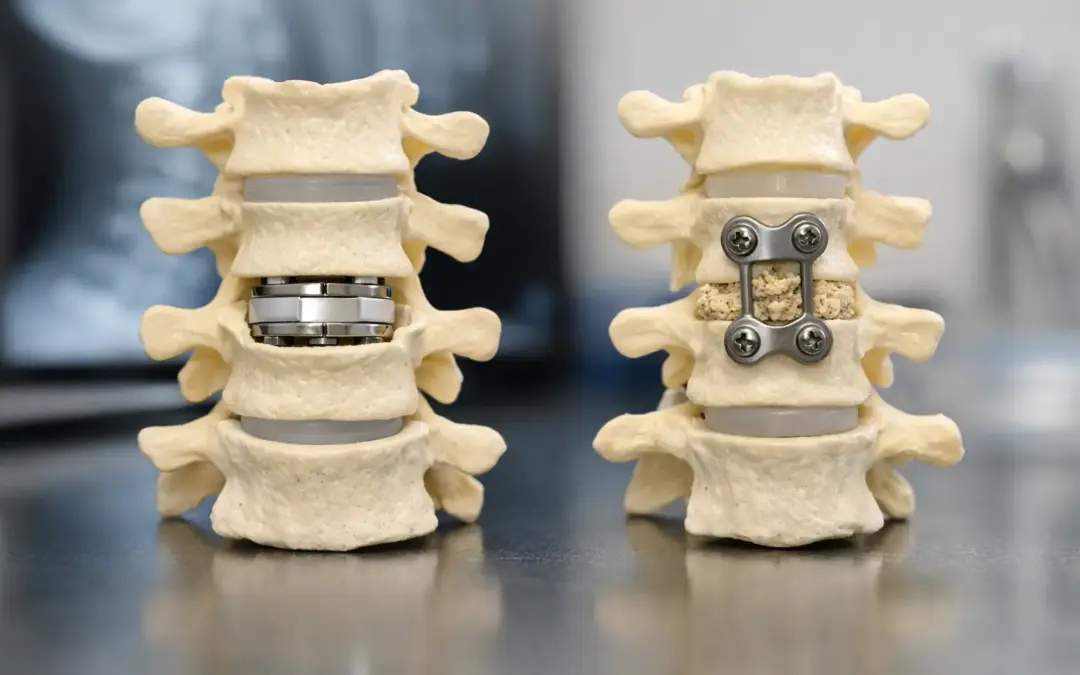 Cervical Disc Replacement vs Fusion Explained