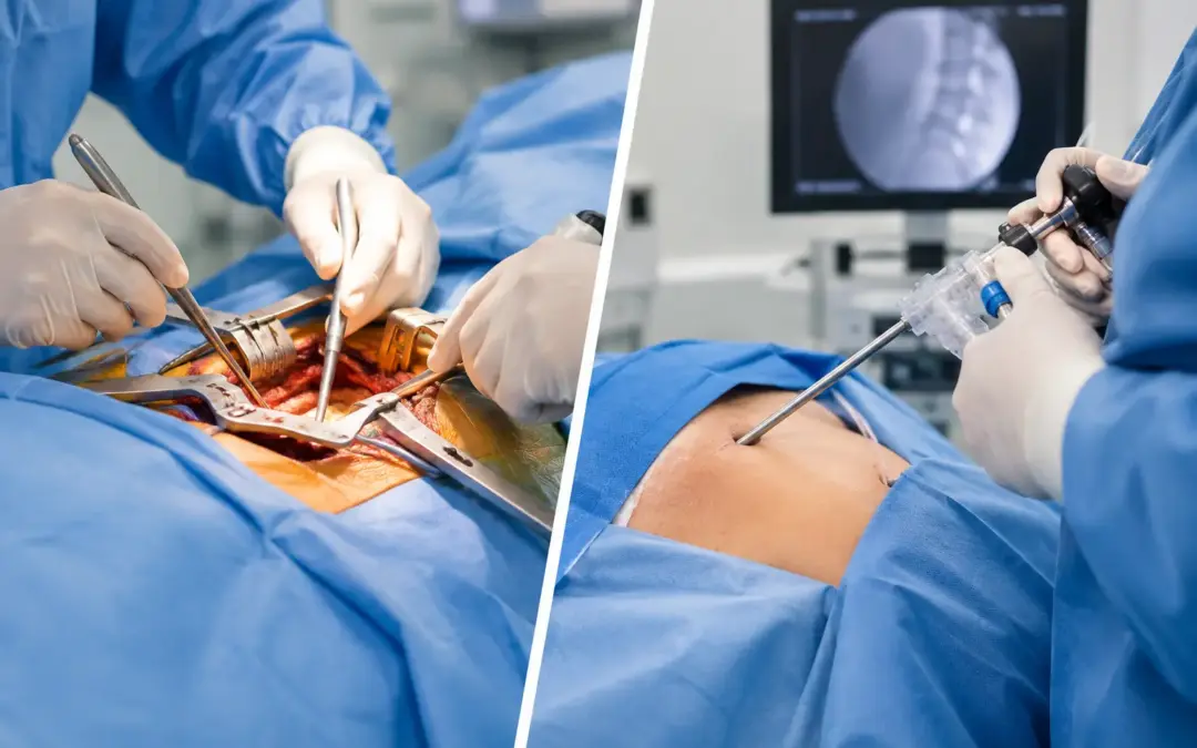 Open Versus Minimally Invasive Spine Surgery